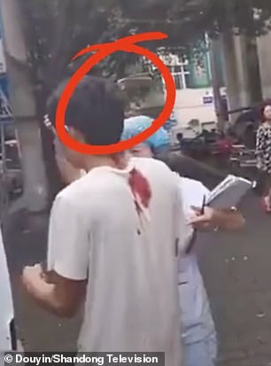 Hombre camina tranquilamente a la ambulancia con un cuchillo clavado en su cráneo